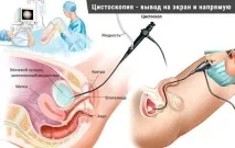 Поліп уретри у жінок лікування, операція та відгуки лікування