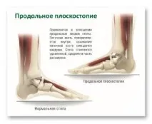 плоскостопість