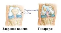 гонартроза помислете