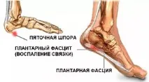 причини петата