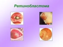 разпространението раковите клетки деца