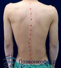 симптоми сколиоза