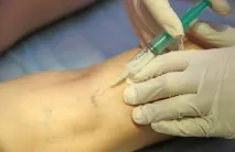 Склеротерапія вен показання, протипоказання та ускладнення ускладнення