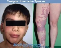засегнатия крайник синдром
