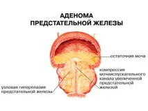 аденом простатата