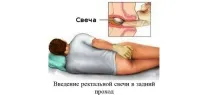 Свічки від аденоми простати - різновиди, альтернативи свічки