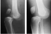 нараняване става