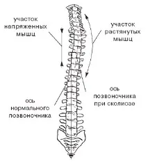 видове сколиозата