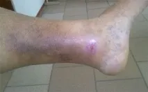 ногах