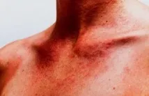 васкулит васкулит