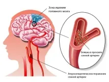 запушване каротидната ангиография
