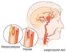 ангиография каротидна артерия