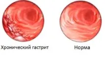 пилори бактерии