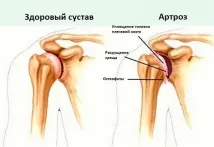 артроза