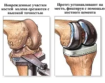 артрит