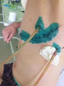 белия болезнени