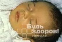 Хвороба Вільсона-Коновалова - діагностика, лікування, ознаки вільсона-коновалова