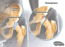 Болі в правому кульшовому суглобі причини, симптоми, лікування болі