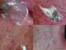 Хвороба Моргеллонів (Morgellons) захворювання