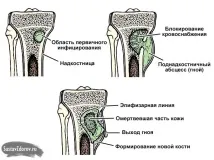 Болі в правому кульшовому суглобі причини, симптоми, лікування правому