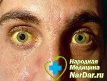 симптоми гилбърт