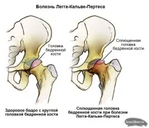 Болі в правому кульшовому суглобі причини, симптоми, лікування причини