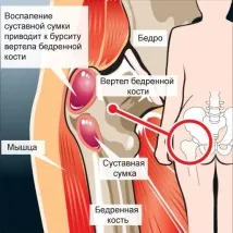 Болі в правому кульшовому суглобі причини, симптоми, лікування болі