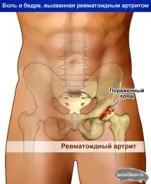 Болі в правому кульшовому суглобі причини, симптоми, лікування болі