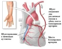 какво присаждането