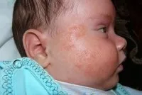 народни диатеза