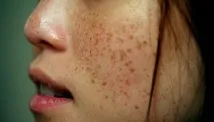 невус невус