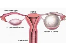 причини яйчниците