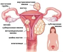 показания esmya