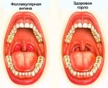 фолікулярна