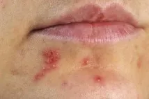 лекува лекува