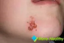 народно лечение