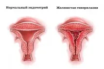 ендометриална хиперплазия