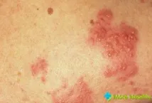 върху херпес