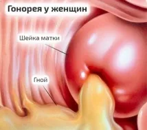 Гонорея – який лікар лікує та до кого звертатися лікує