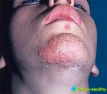 лечение народно