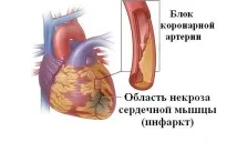 Інфаркт на ногах симптоми, причини та наслідки інфаркту, перенесеного на ногах інфаркту