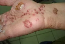 период инкубационният