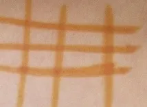 Йодна сітка, користь чи шкода йодна