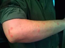 Як виявити клопів у ліжку запах, сліди, укуси виявити