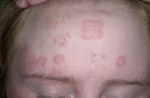 лечение лечение