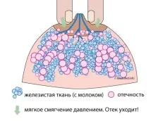 Кам’яні груди - що робити груди