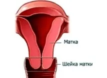 Кіста на статевій губі губі