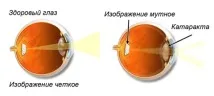 ускладнення