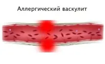 алергичен васкулит васкулит