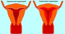 ендометриална ендометриална